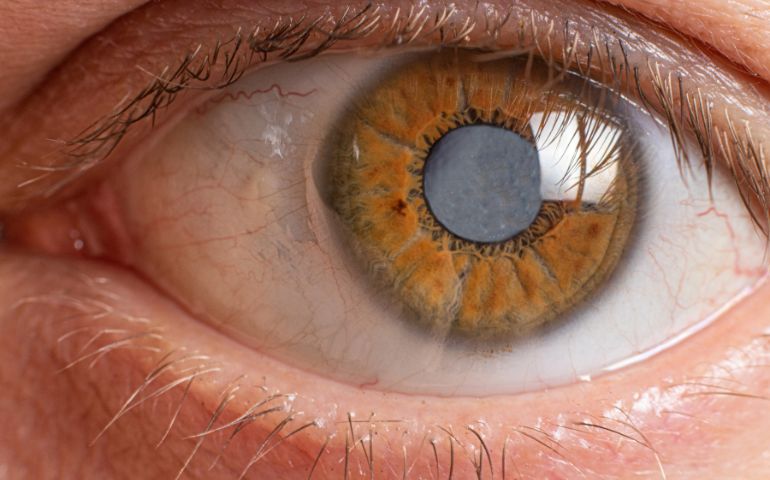 ¿Qué son las cataratas y por qué afectan nuestra visión?